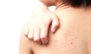 小児アトピー治療